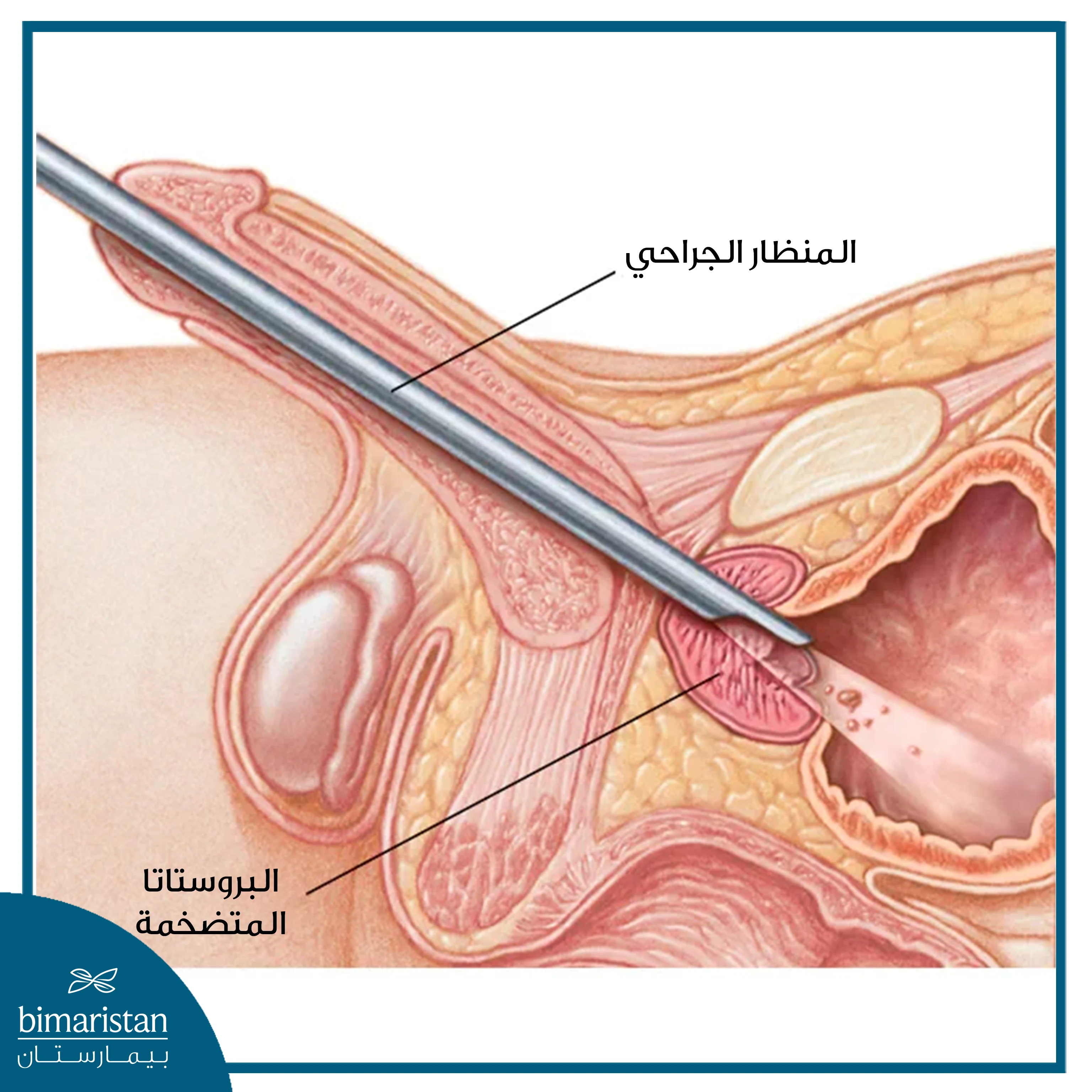 عملية استئصال البروستاتا عبر الإحليل