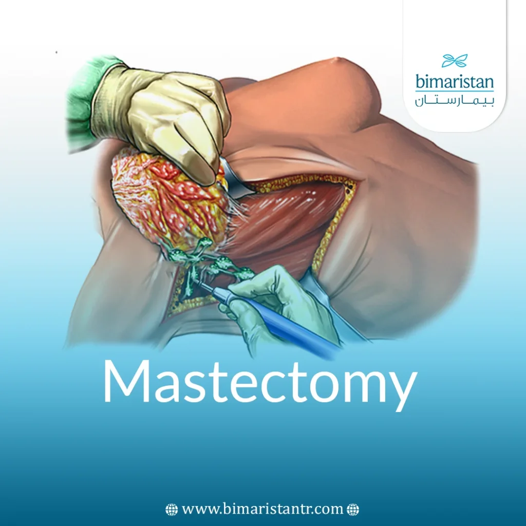 عملية استئصال الثدي المصاب بالسرطان