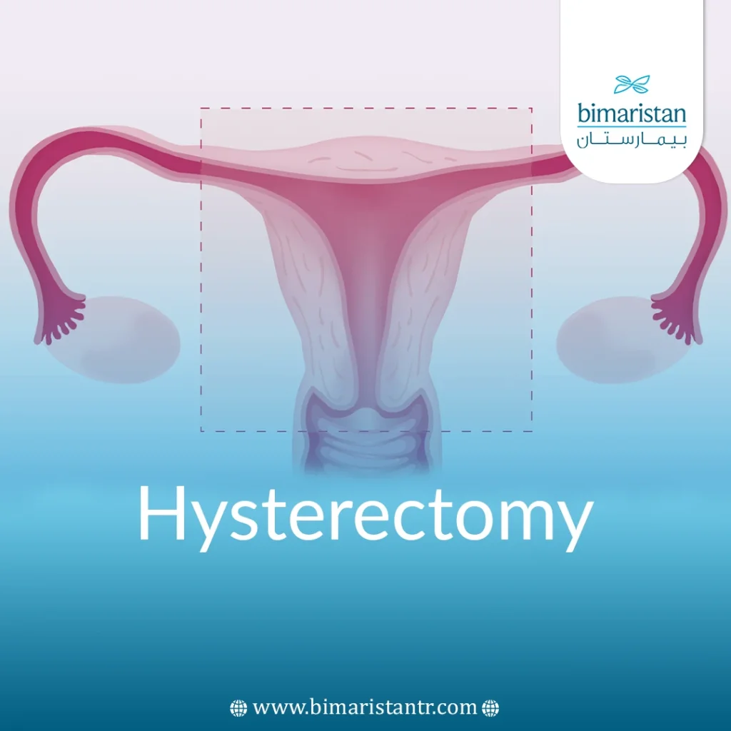 Hysterectomy