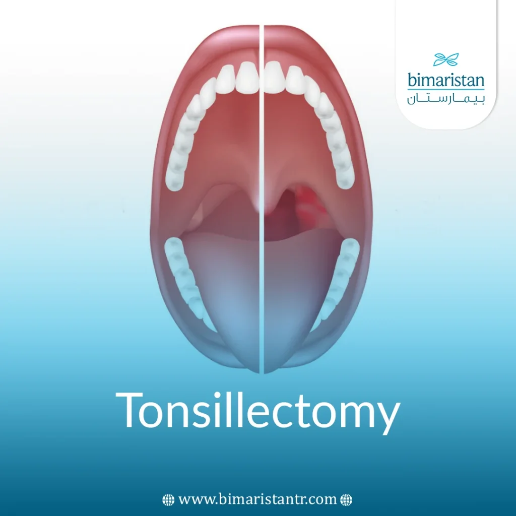 Tonsillectomy In Turkey