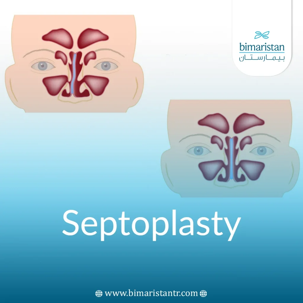 Septoplasty