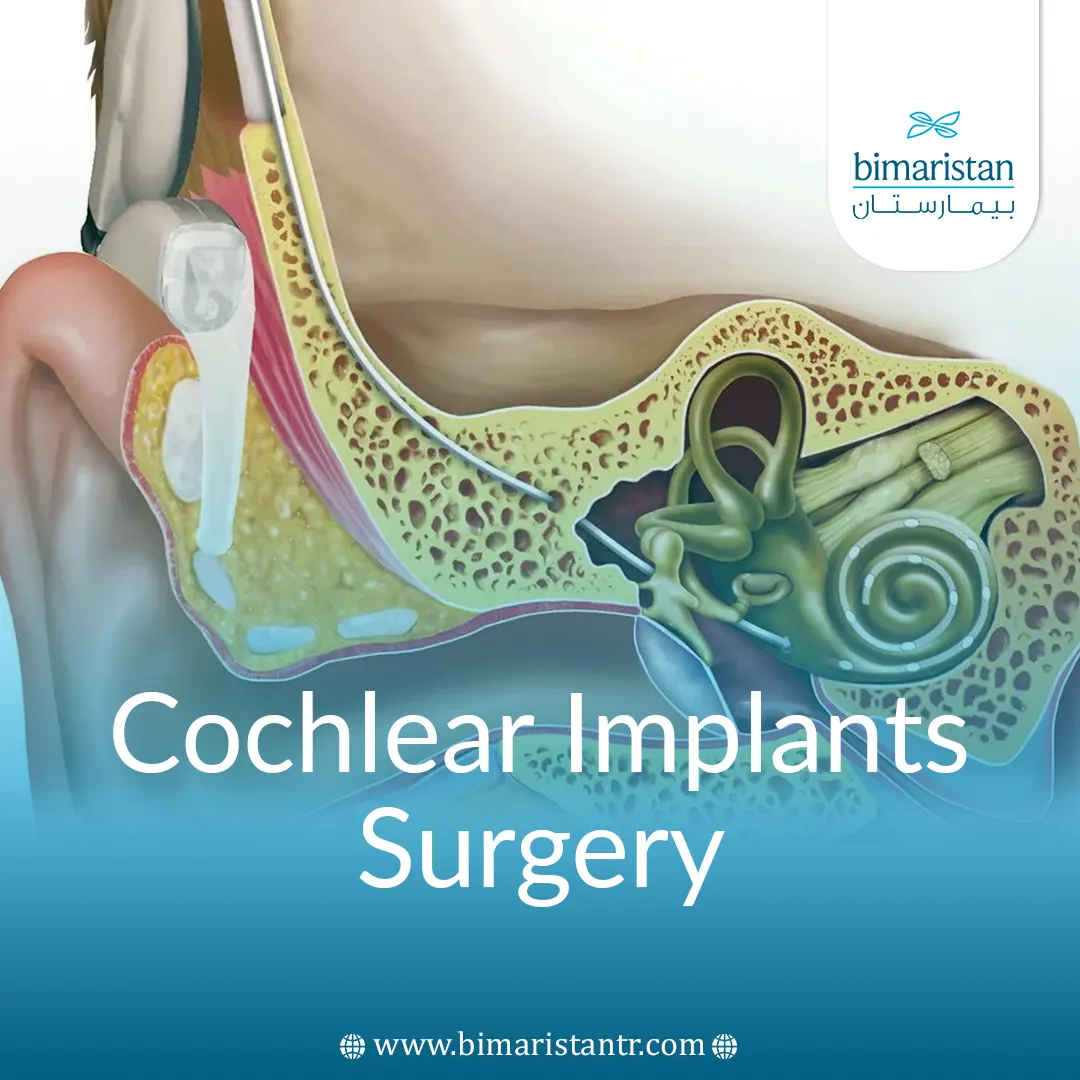 Cochlear Implants Surgery