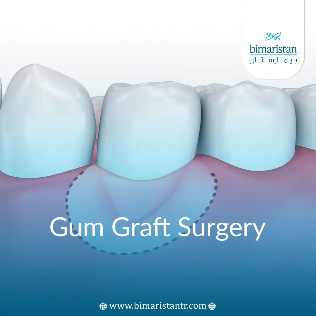 Gum Implant Surgery In Turkey