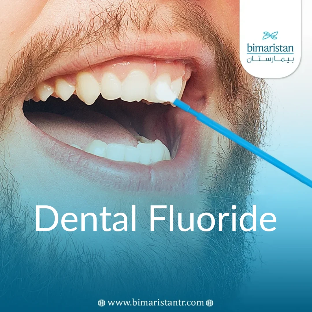 Dental Fluoride