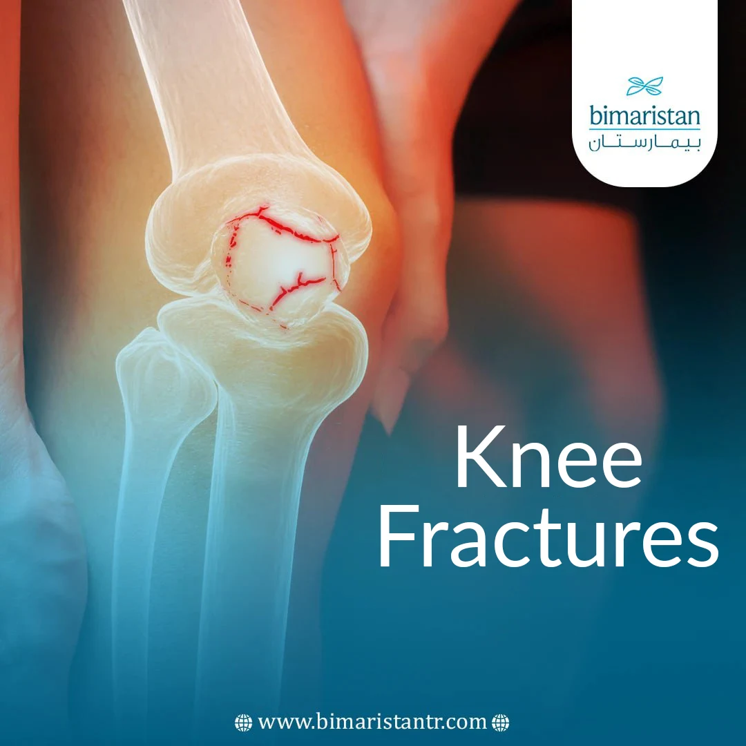 Knee Fractures