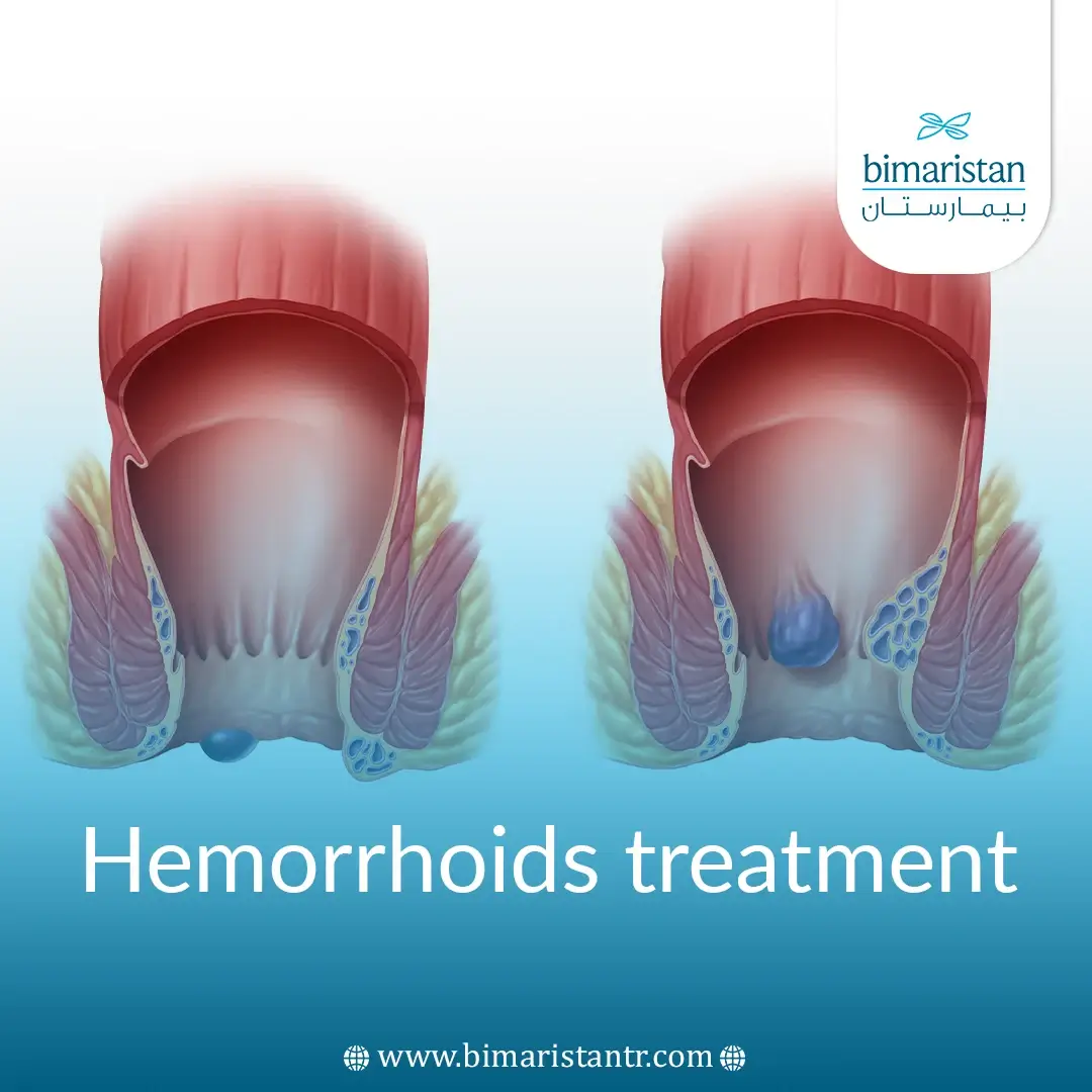 Hemorrhoids Treatment: Everything You Want To Know About It In Turkey