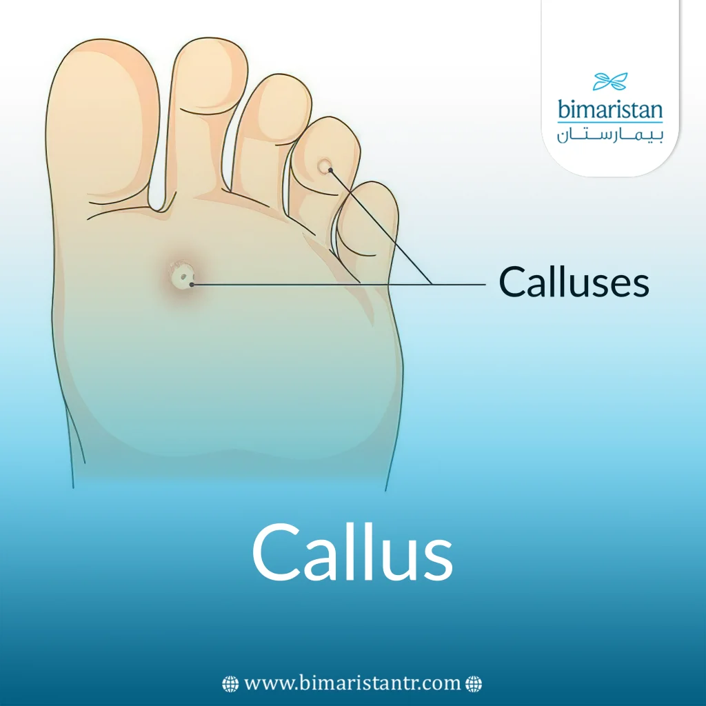 Callus