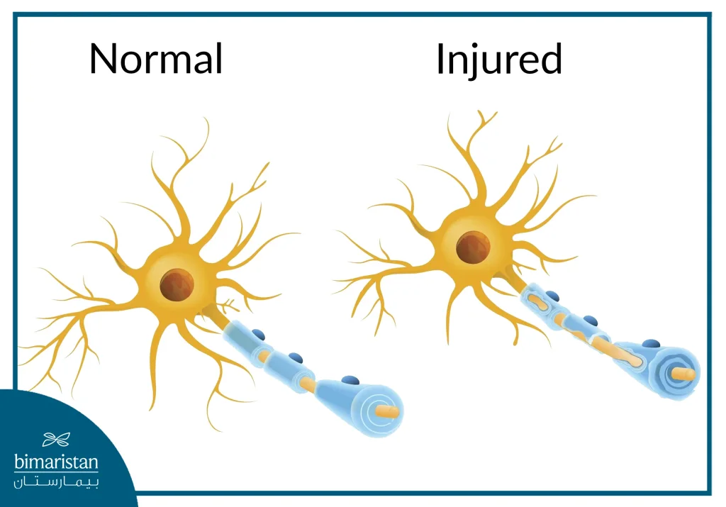 The Body'S Immune System Attacks The Nerve Fiber Sheaths In Multiple Sclerosis.