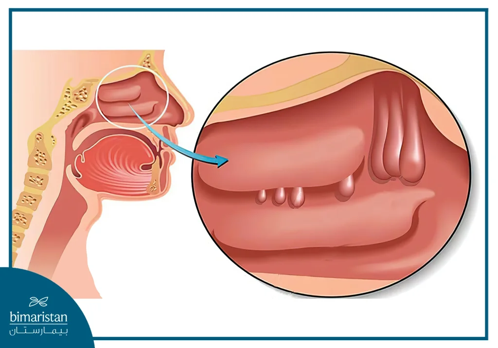 Nasal Polyps