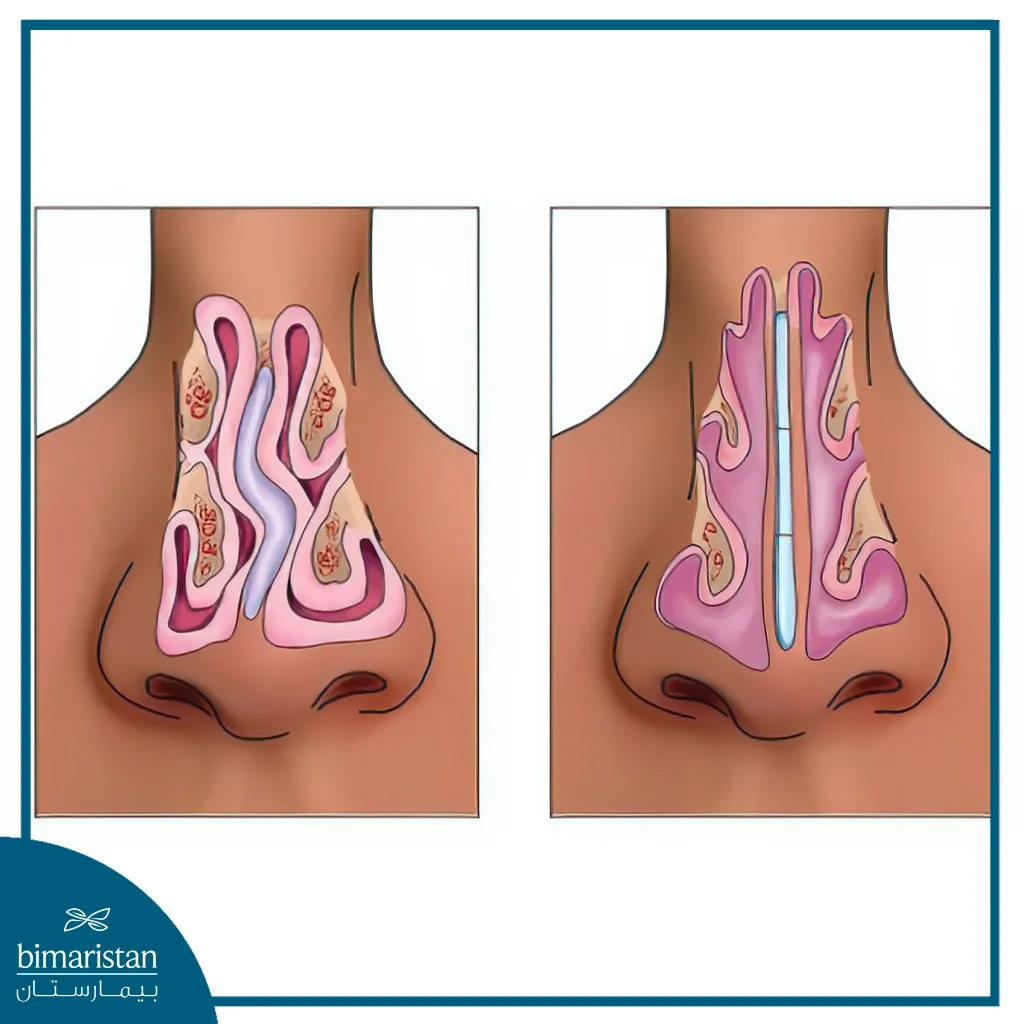 Nasal Septum Deviation