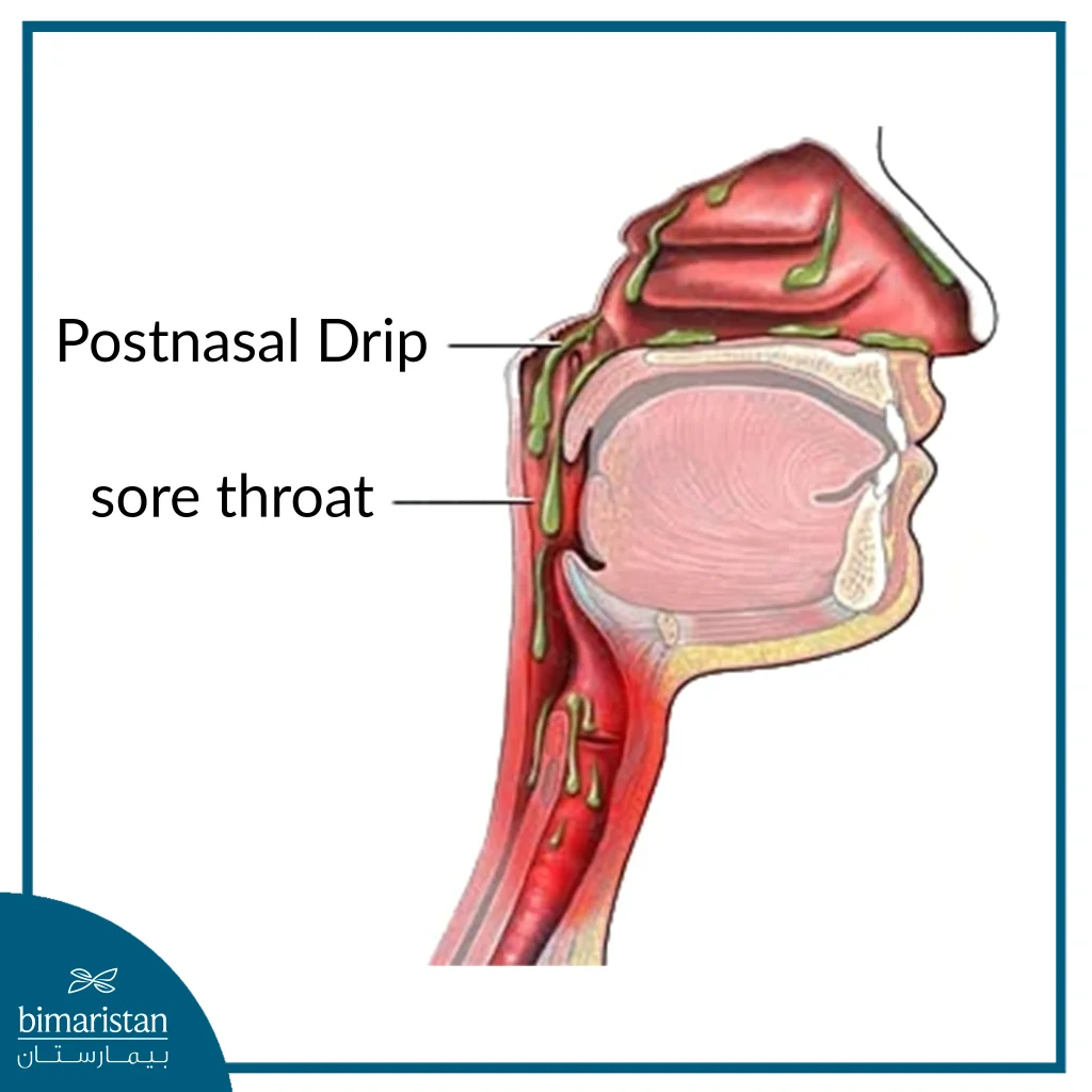 Postnasal Drip