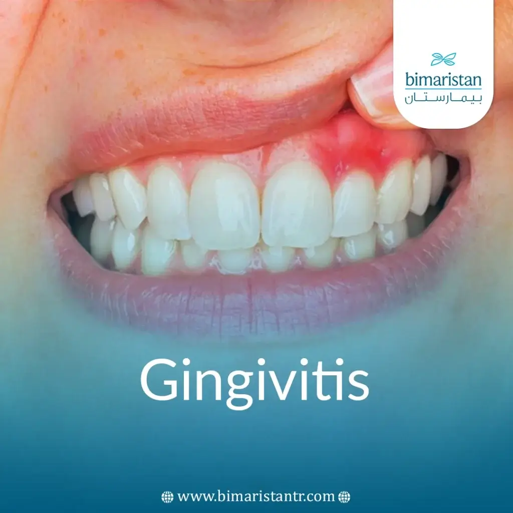Gingivitis: Everything You Need to Know About Treating Inflamed Gums -  بيمارستان, image size:1024x1024