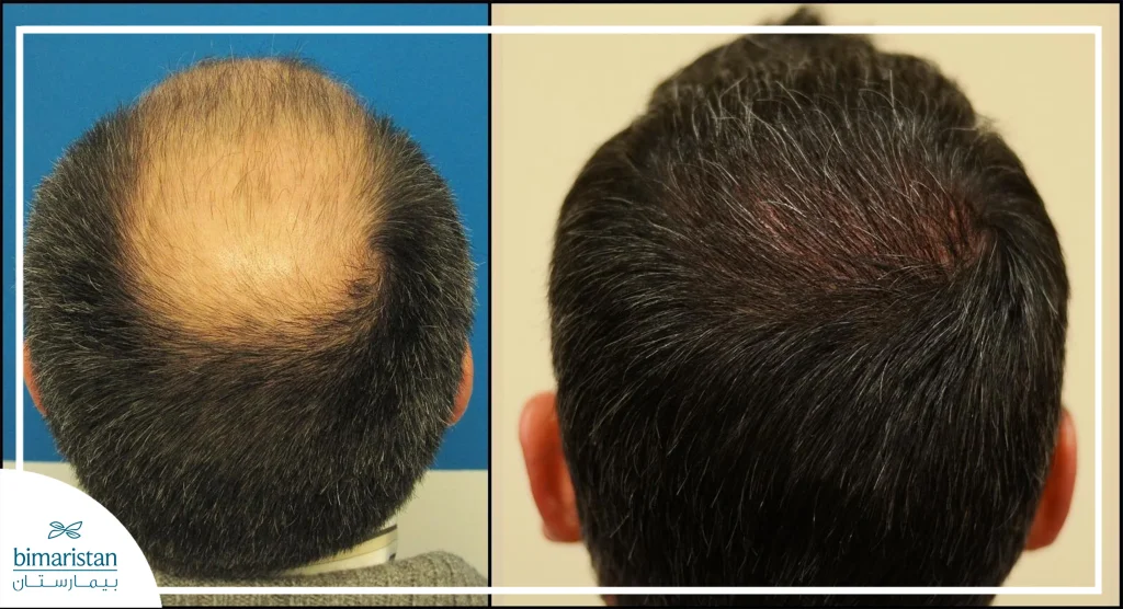 This Image Shows The Experience Of A Person Who Underwent Hair Transplantation Using Stem Cell Hair Therapy, Which Is Performed In Specialized Centers In Turkey.