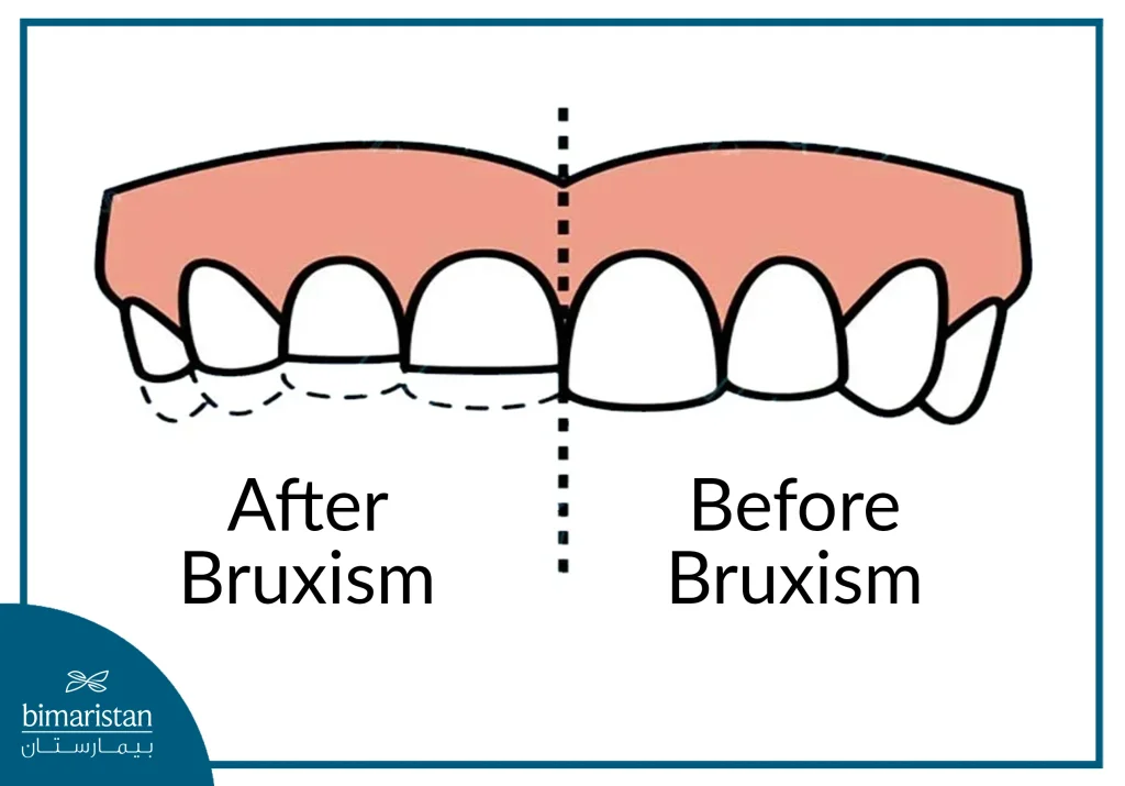 Before And After Bruxism