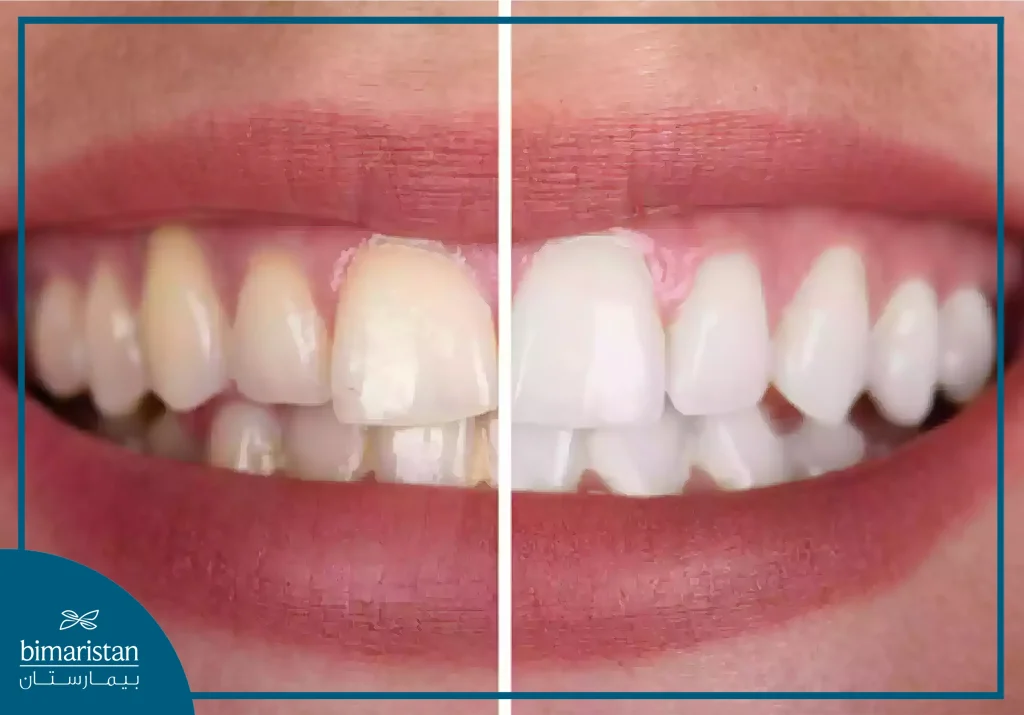 On The Left The Teeth Appear Darker Before Whitening And On The Right They Appear Lighter After Whitening