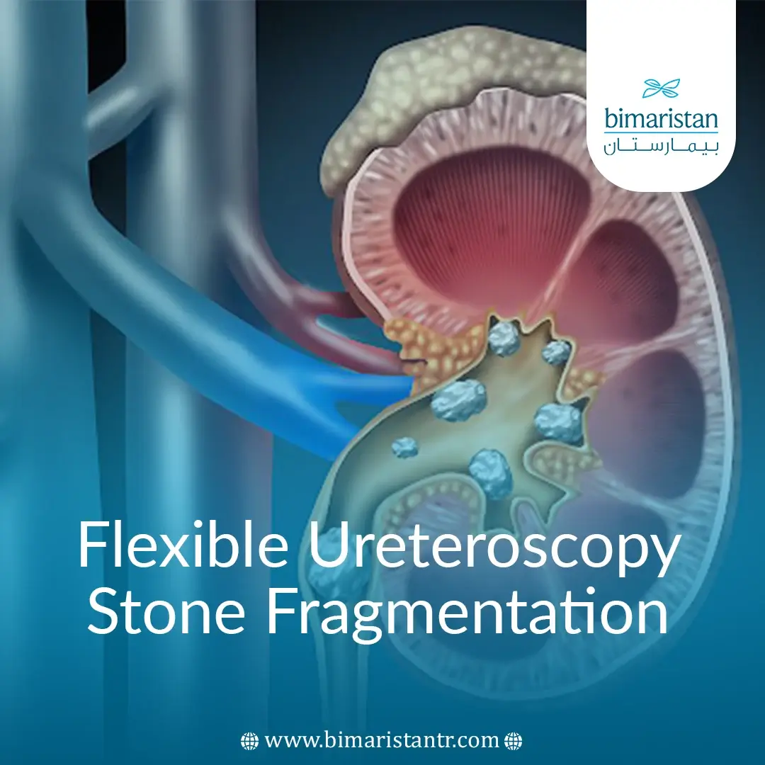 Flexible Ureteroscopy Stone Fragmentation - بيمارستان