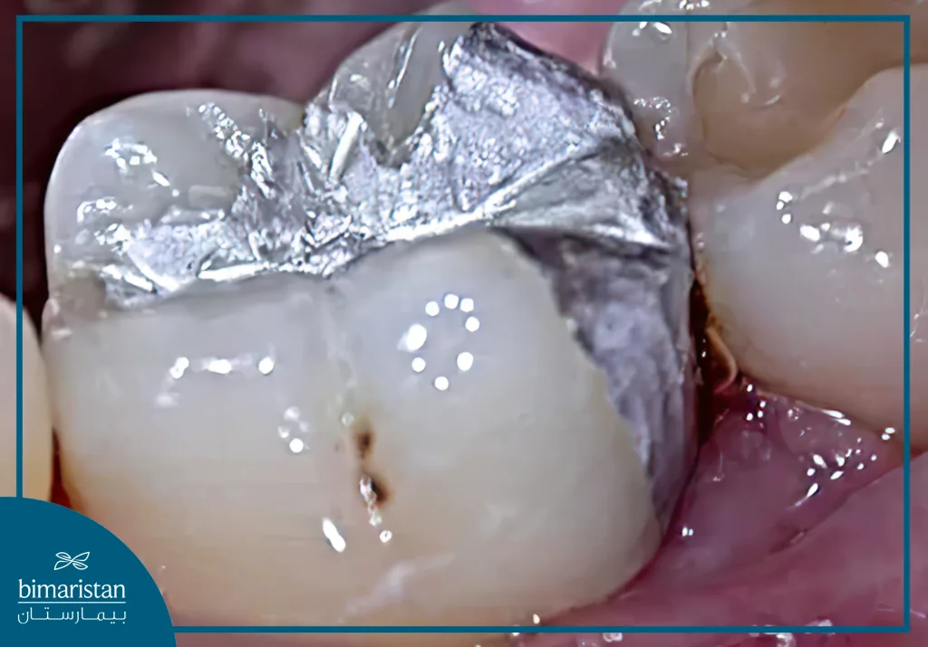 Dental Amalgam Fillings