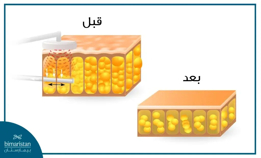 النسيج الدهني تحت الجلد قبل وبعد عملية شفط الدهون