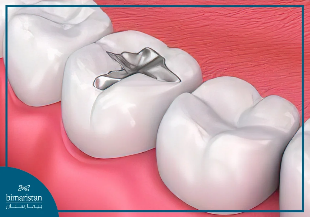 Silver Dental Amalgam Fillings