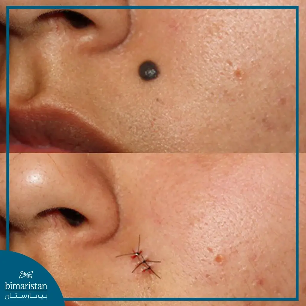 Before And After Mole Removal From The Face Via Surgery