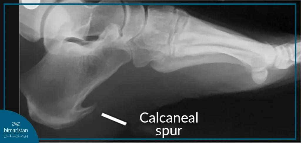 X-Ray Showing Heel Spurs