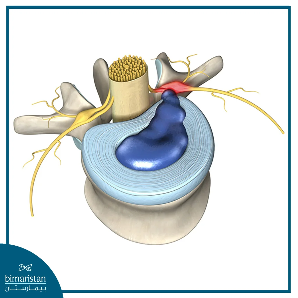 The Outer Part Of The Intervertebral Disc Tears, Causing The Nucleus Pulposus To Rupture And Press On The Spinal Nerve.