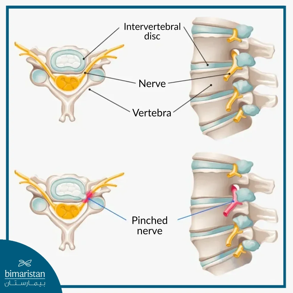 Compression Of The Cervical Nerves Due To A Cervical Disc Herniation Causes Cervical Radiculopathy