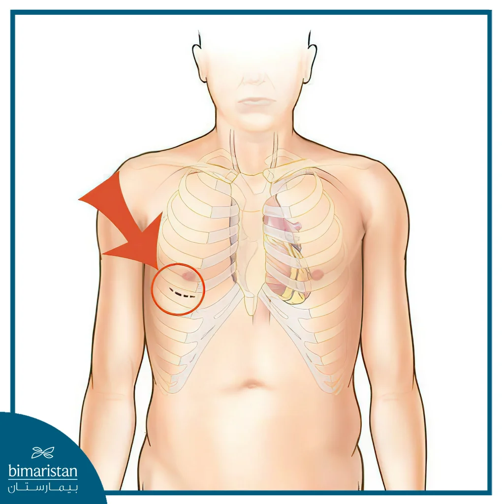 Shape And Location Of The Surgical Incision In Robotic Mitral Valve Replacement Surgery