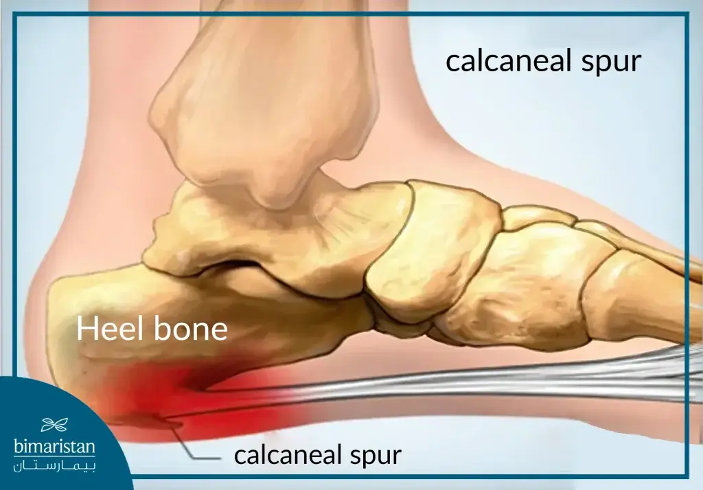 Image Showing The Formation Of A Heel Spurs On The Heel Bone And Its Irritation Of The Surrounding Tissue