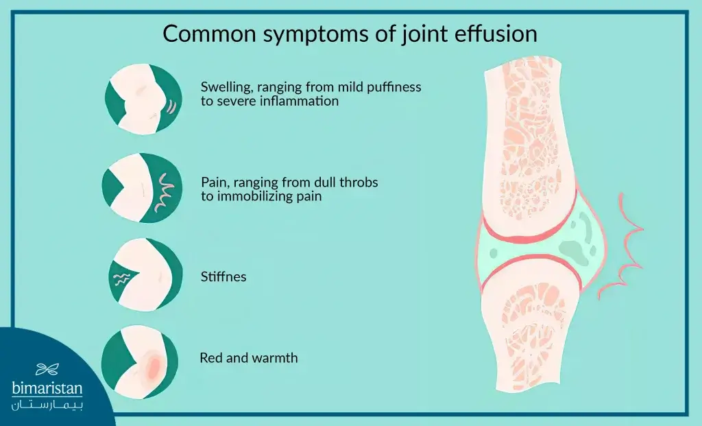 Symptoms Of Knee Effusion