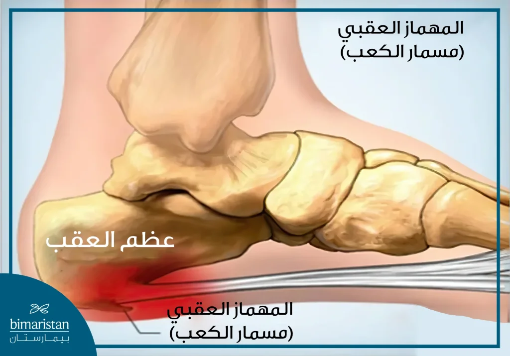 صورة توضح تشكل مسمار كعب القدم على عظم العقب وتخريشه للأنسجة المجاورة