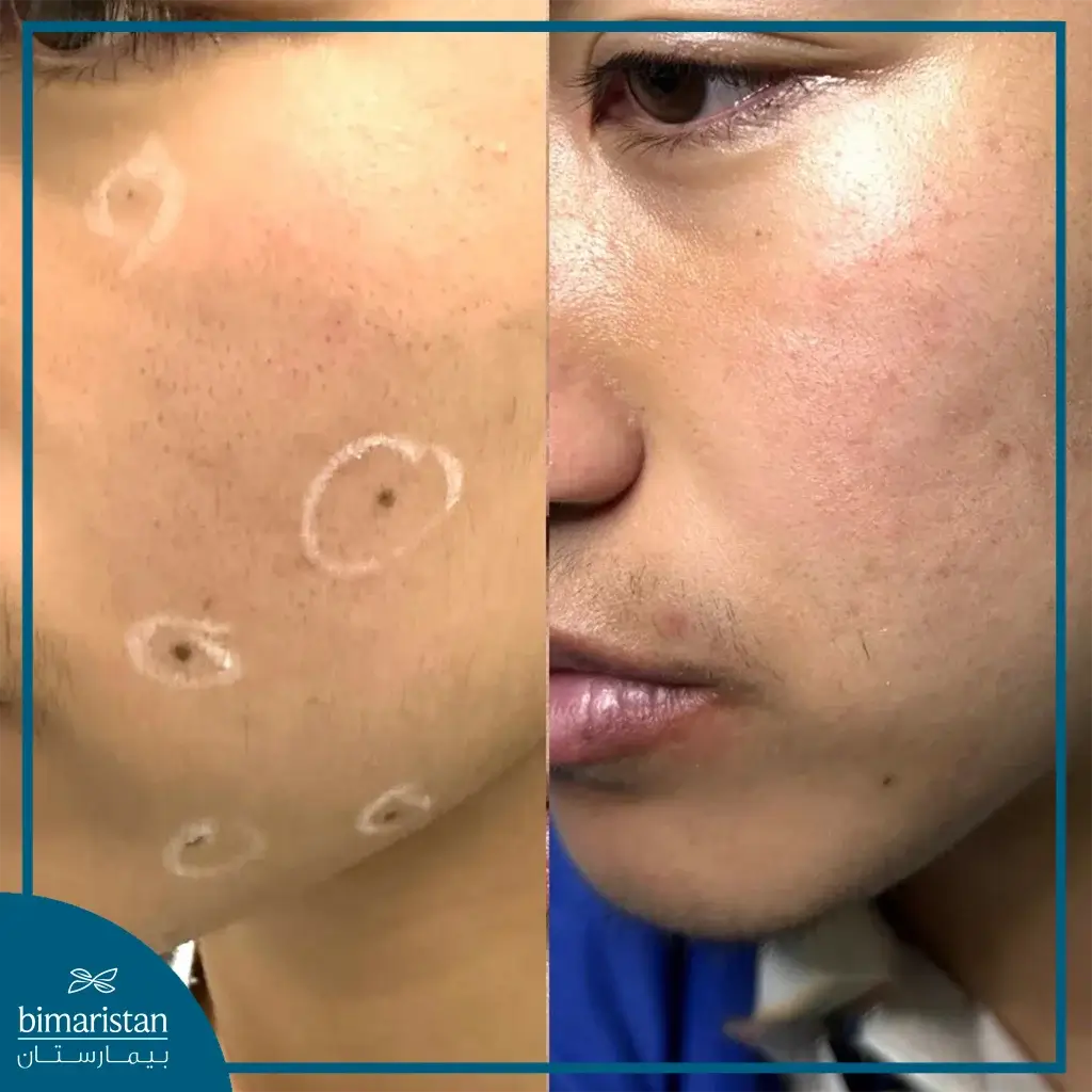 Before And After Using The Laser To Remove Moles From The Face