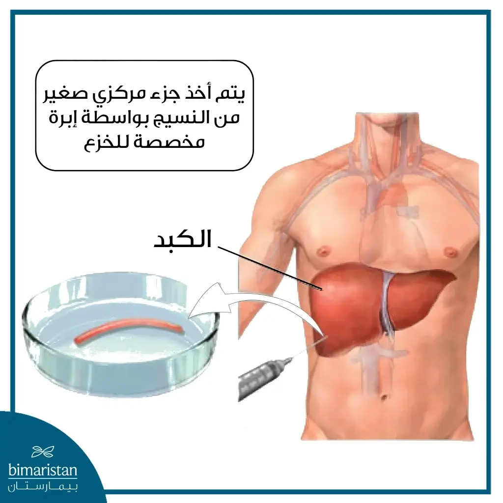 تظهر عملية أخذ الخزعة الكبدية في هذه الصورة بواسطة إبرة خازعة خاصة