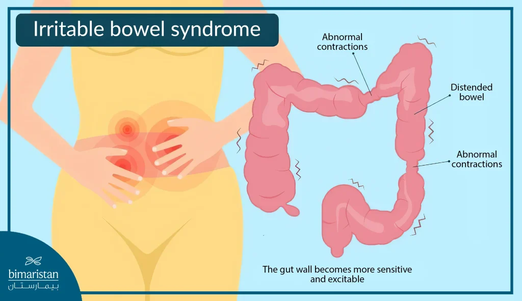 Irritable Bowel Syndrome 