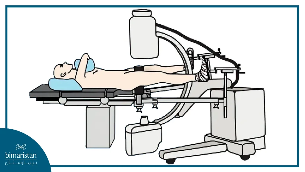 An Image Showing One Of The Patient'S Positions During Hip Arthroscopy.