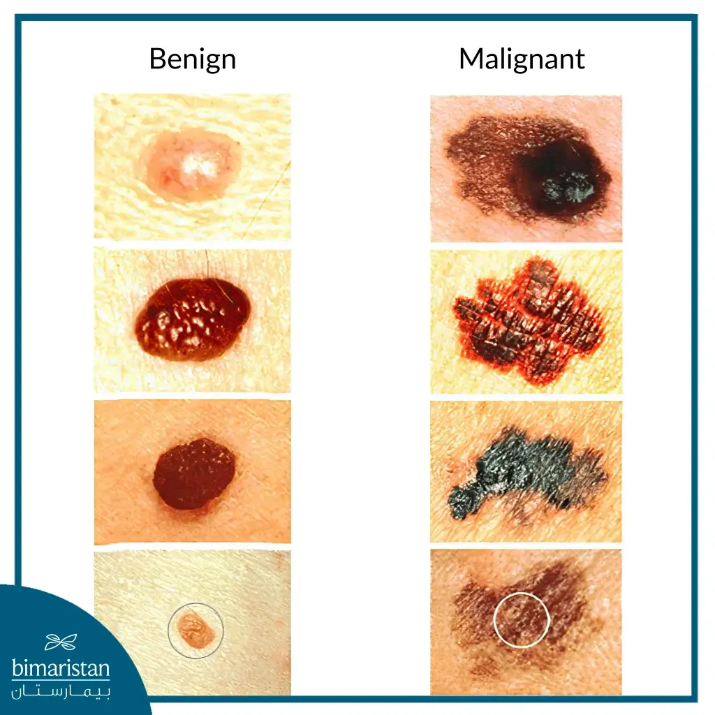 Difference Between Malignant Skin Moles And Benign Moles