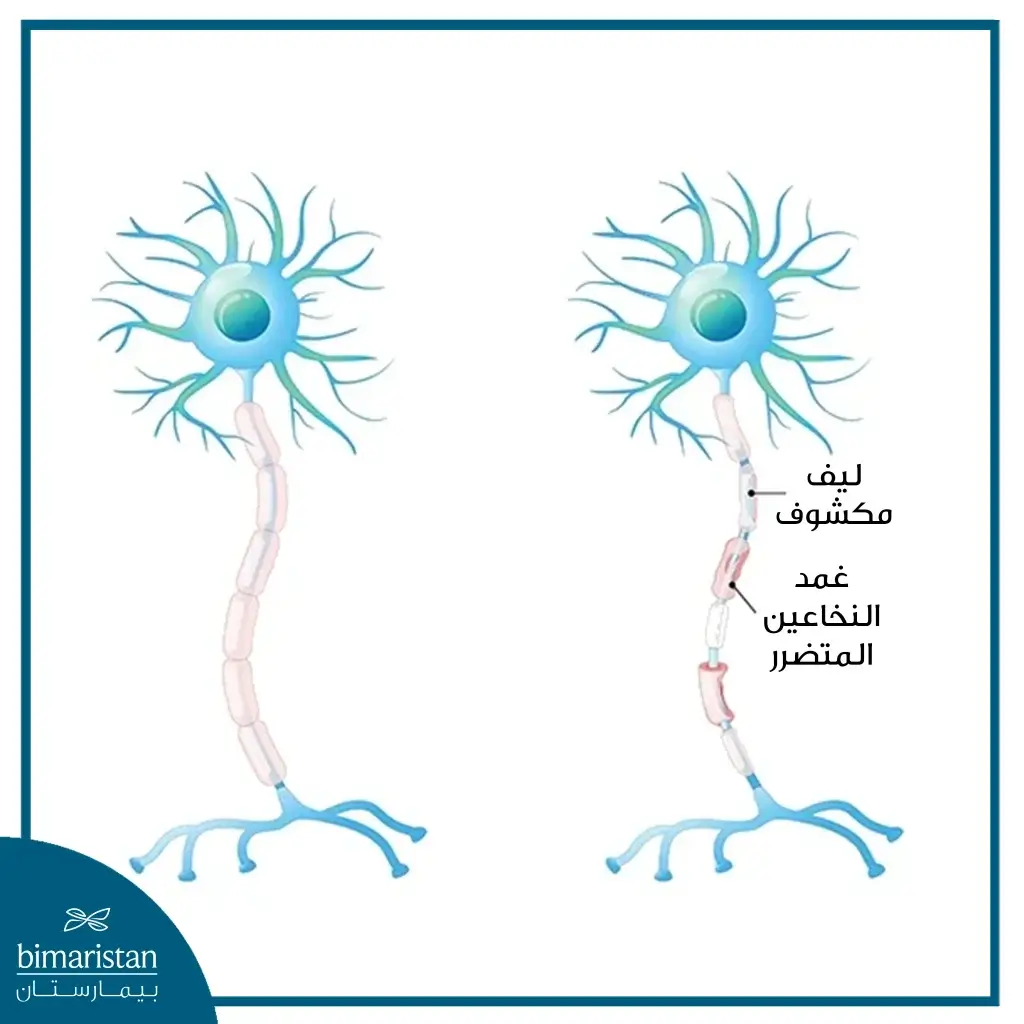 صورة توضح تخرب غمد الألياف العصبية في مرض التصلب اللويحي