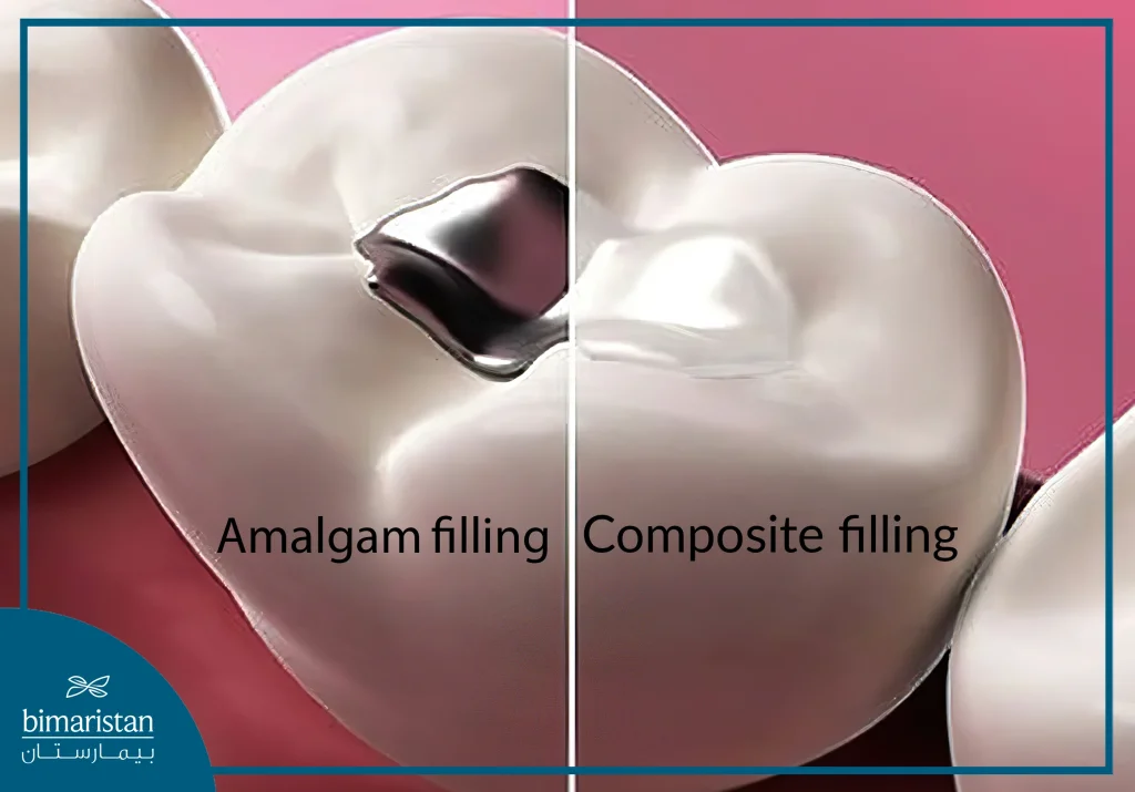 Amalgam Fillings Are Silver-Colored While Composite Fillings Are Tooth-Colored