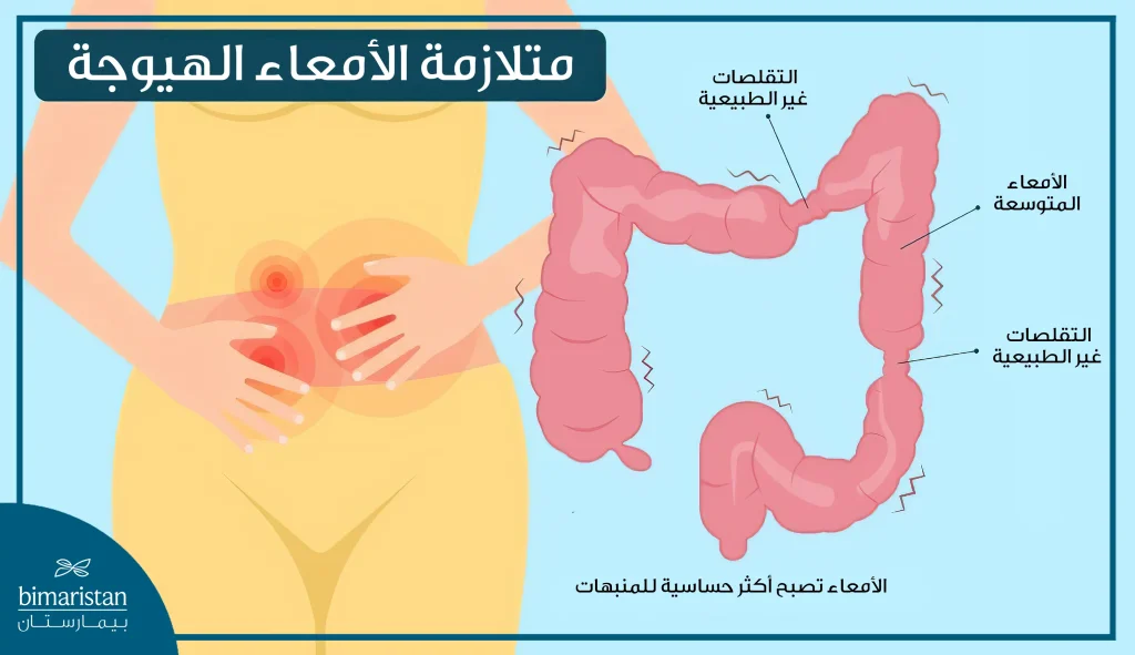 متلازمة الأمعاء الهيوجة (القولون العصبي)