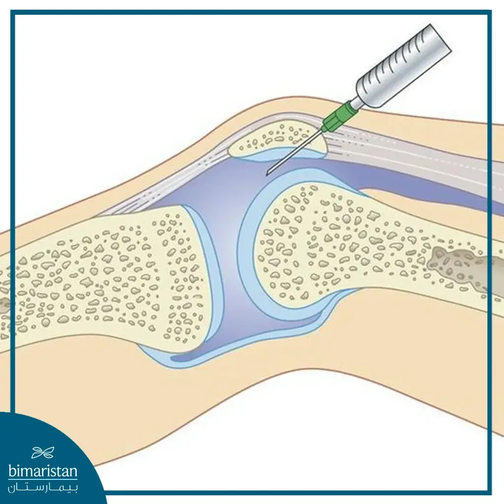 Treatment of Mild Knee Joint Effusion and its Diagnosis - بيمارستان