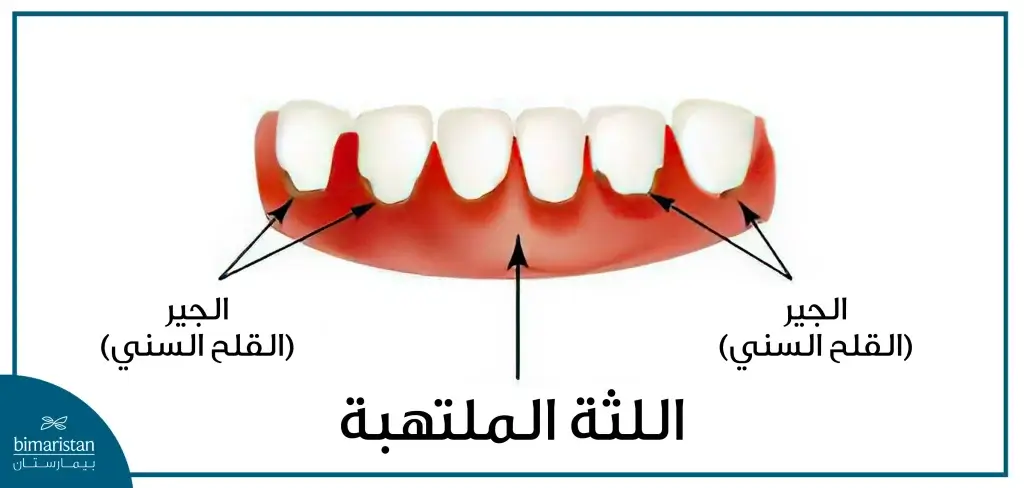 الجير المسبب للالتهاب في اللثة