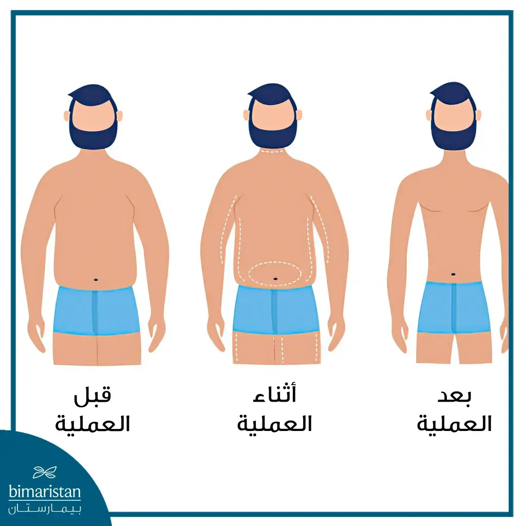 قبل وأثناء وبعد عملية نحت الجسم وشفط الدهون