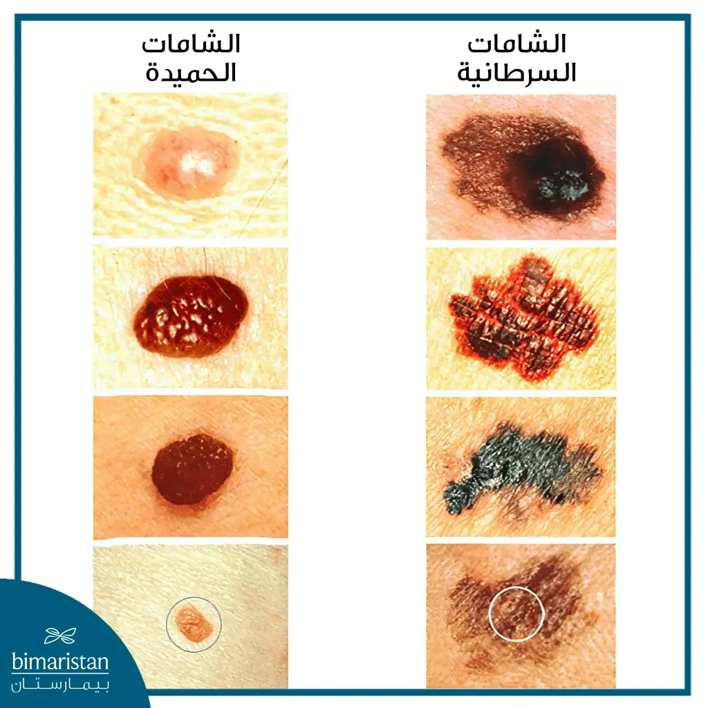 الفرق بين أشكال الشامات السرطانية وأشكال الشامات الحميدة