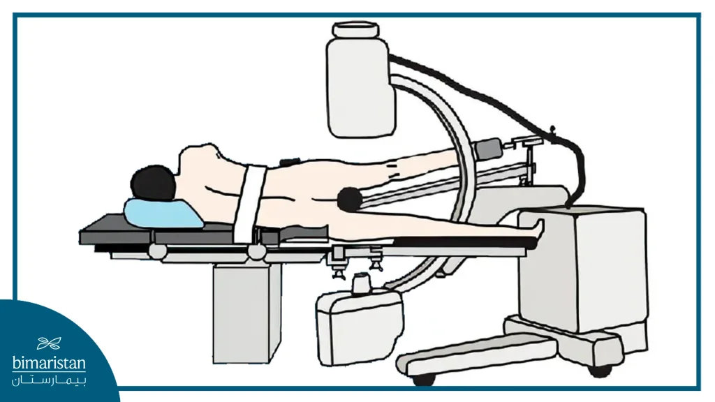 An Image Showing One Of The Patient'S Positions During Hip Arthroscopy In Turkey.