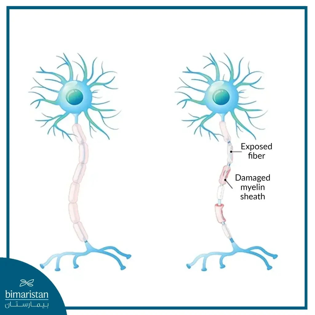 Image Showing Damage To The Nerve Fiber Sheath In Multiple Sclerosis