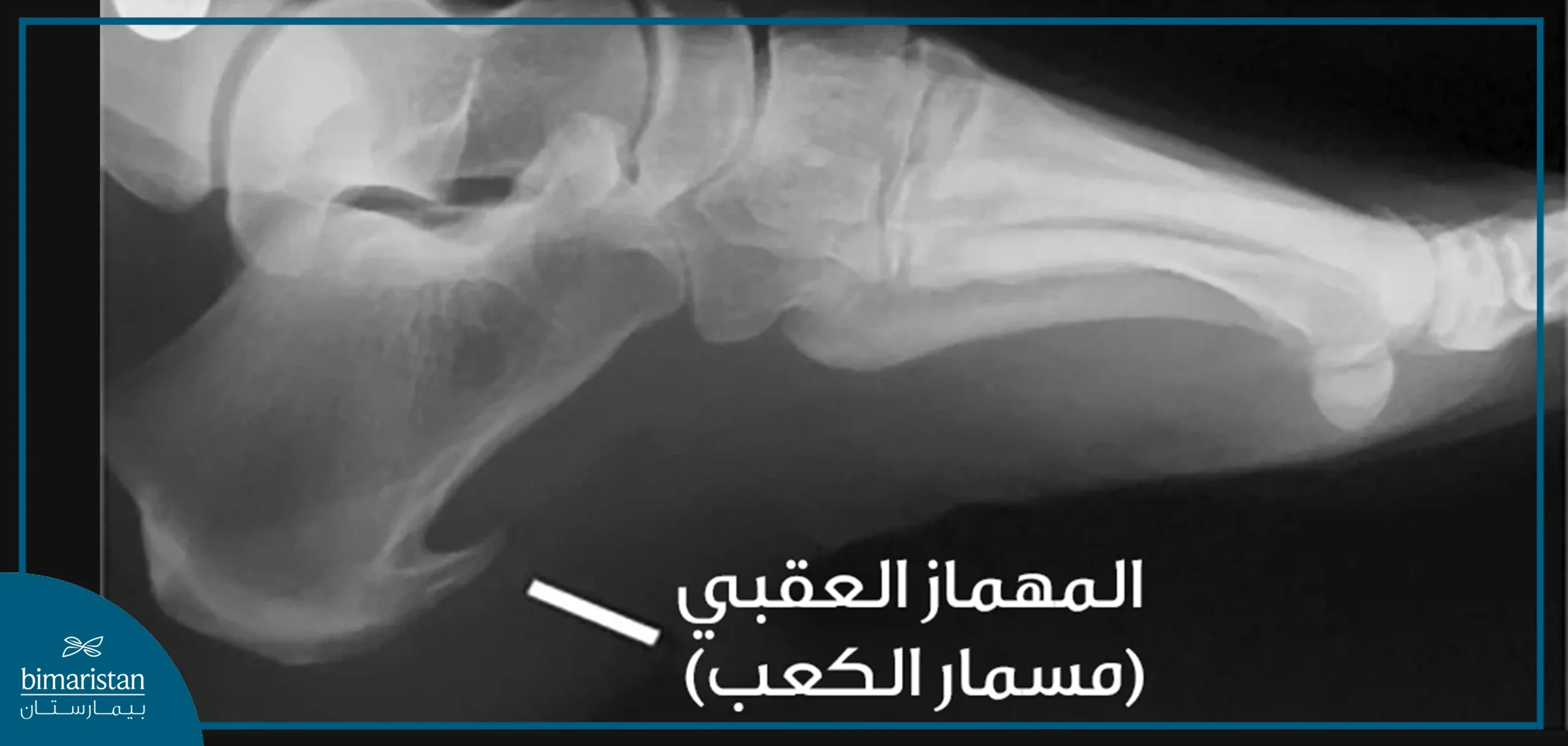 صورة شعاعية توضح مسمار كعب القدم