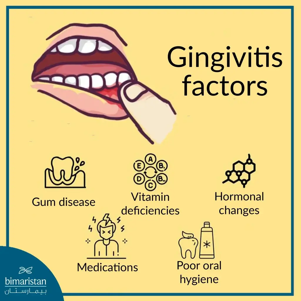 Causes Of Gingivitis