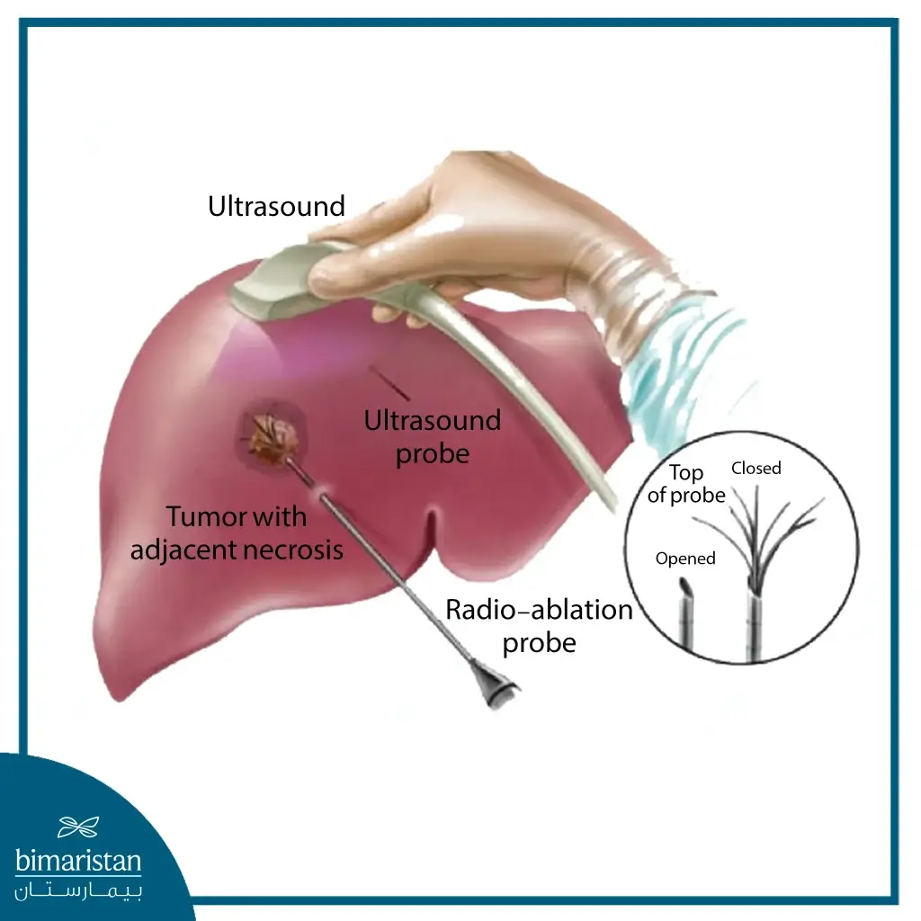 Ultrasound Probe Combined With Radiofrequency Probe To Heat And Destroy The Tumor For Liver Cancer Treatment