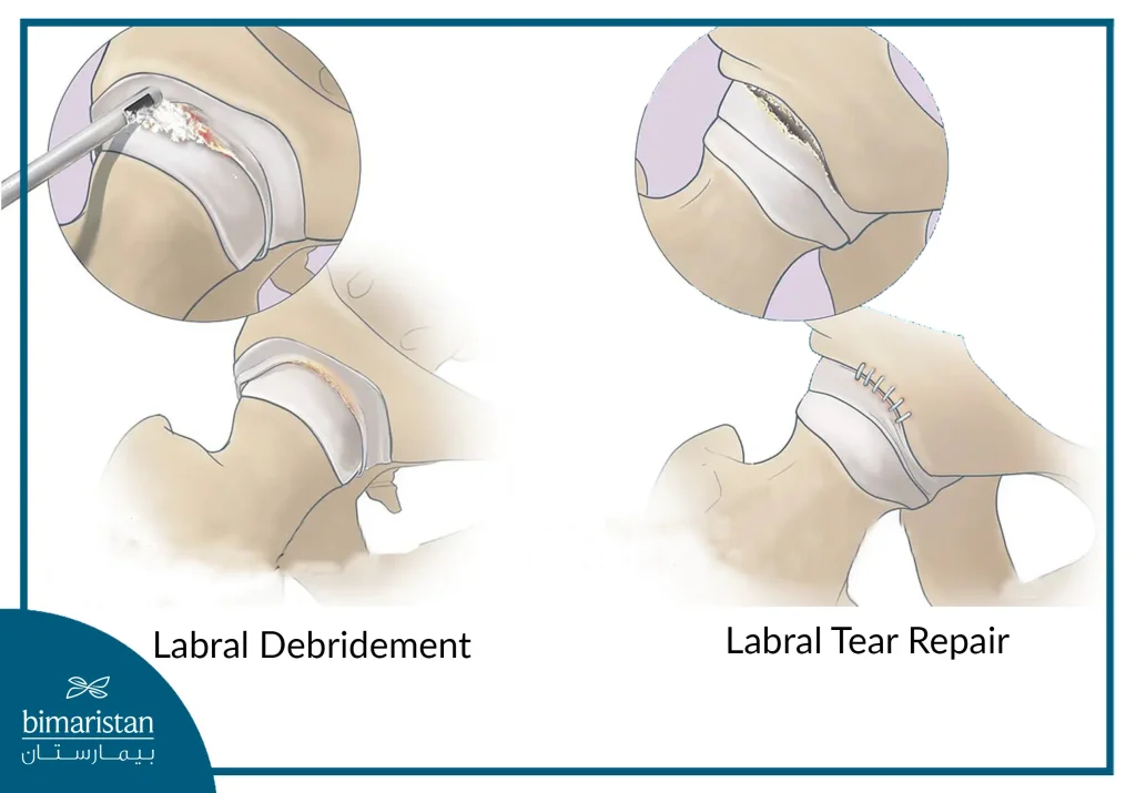 The Image Illustrates What Can Be Repaired During A Hip Arthroscopy Procedure.