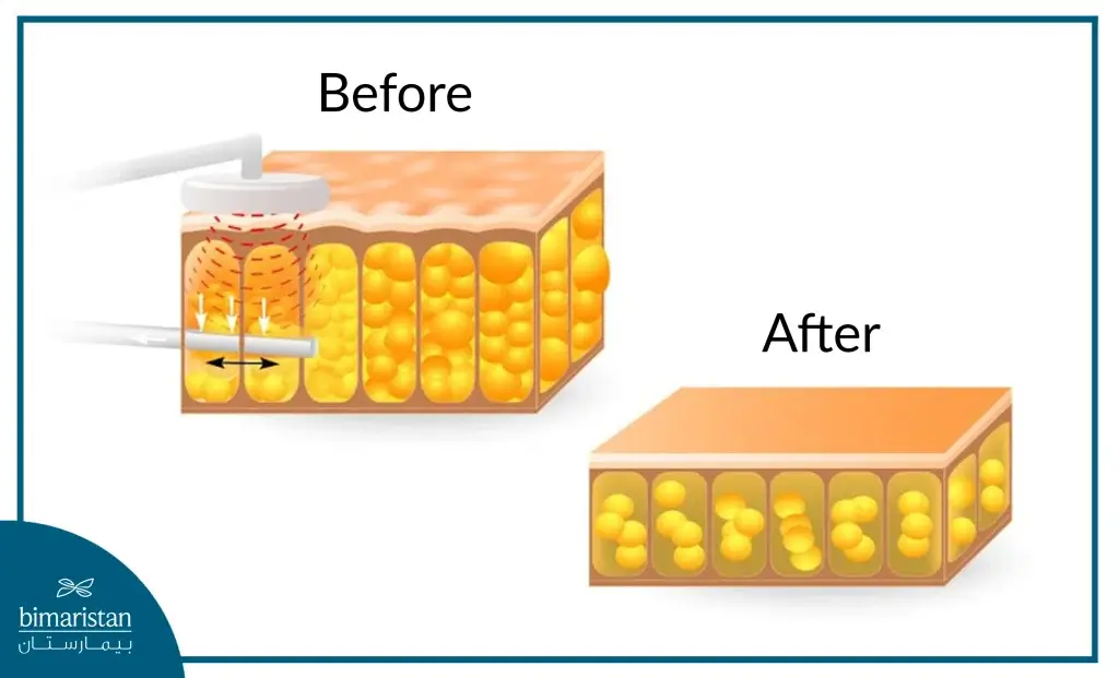 Subcutaneous Fatty Tissue Before And After Liposuction